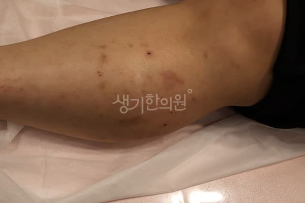 아토피 치료 전 사진 — 분당점, 치료 기간 3개월