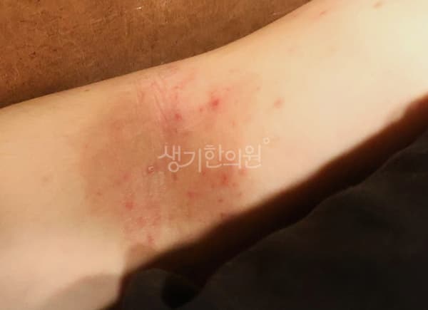 아토피 치료 전 사진 — 분당점, 치료 기간 4개월