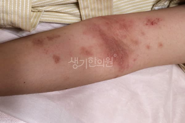 아토피 치료 전 사진 — 분당점, 치료 기간 9개월