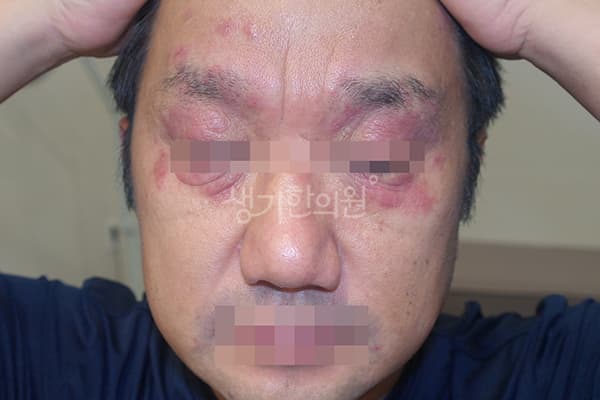 아토피 치료 전 사진 — 천안아산점, 치료 기간 3개월