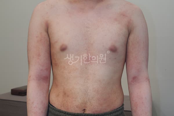 아토피 치료 전 사진 — 천안아산점, 치료 기간 3개월