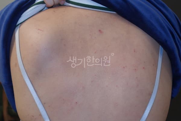 아토피 치료 전 사진 — 천안아산점, 치료 기간 7개월
