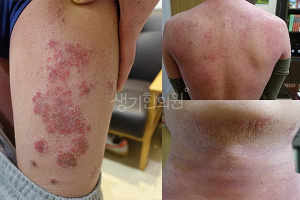 아토피 치료 전 사진 — 광주점, 치료 기간 3개월