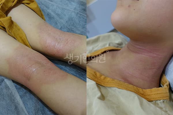 아토피 치료 전 사진 — 일산점, 치료 기간 6개월