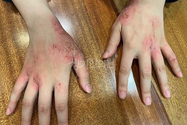 아토피 치료 전 사진 — 잠실점, 치료 기간 8개월