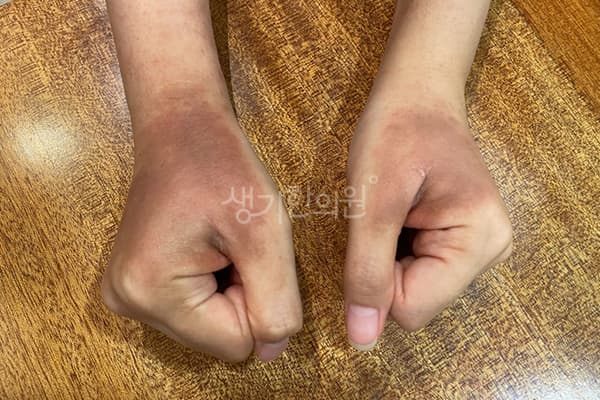 아토피 치료 전 사진 — 잠실점, 치료 기간 6개월
