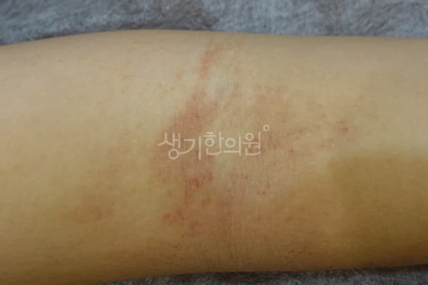 아토피 치료 전 사진 — 노원점, 치료 기간 6개월