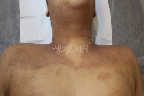 아토피 치료 전 사진 — 수원점, 치료 기간 4개월