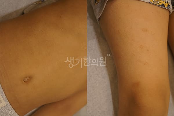 소아아토피 치료 전 사진 — 부산센텀점, 치료 기간 6개월