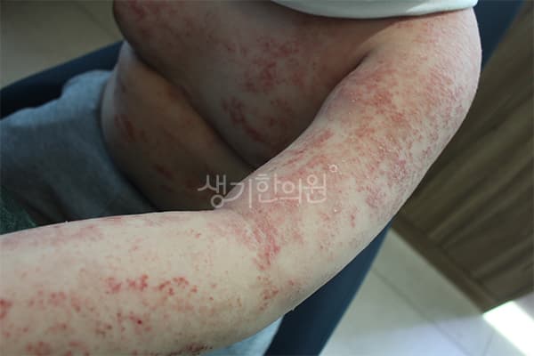 소아아토피 치료 전 사진 — 부산서면점, 치료 기간 5개월