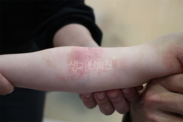 소아아토피 치료 전 사진 — 창원점, 치료 기간 22개월