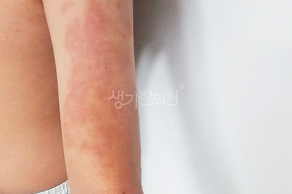 소아아토피 치료 전 사진 — 창원점, 치료 기간 6개월