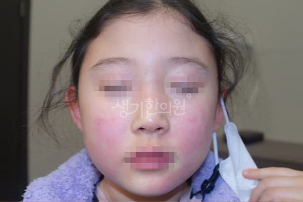 소아아토피 치료 전 사진 — 천안아산점, 치료 기간 4개월