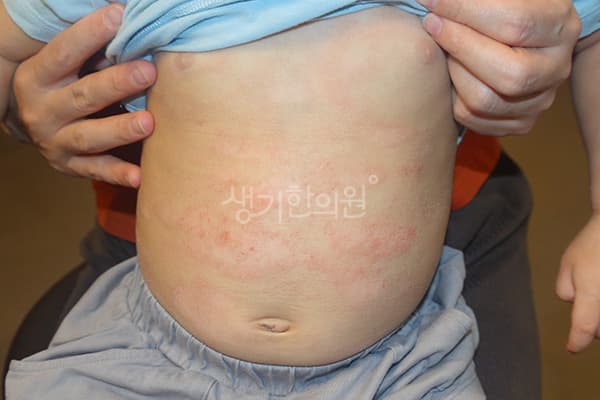 소아아토피 치료 전 사진 — 천안아산점, 치료 기간 3개월