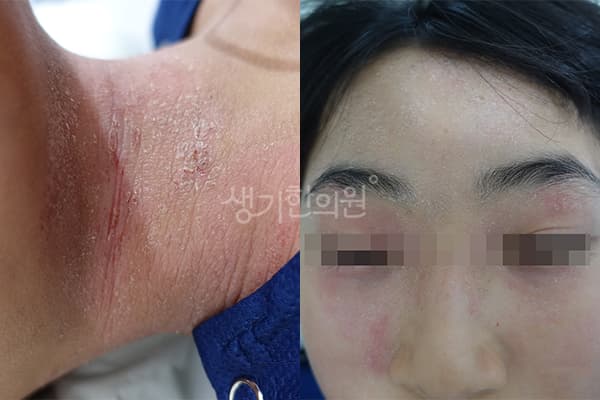 소아아토피 치료 전 사진 — 광주점, 치료 기간 5개월