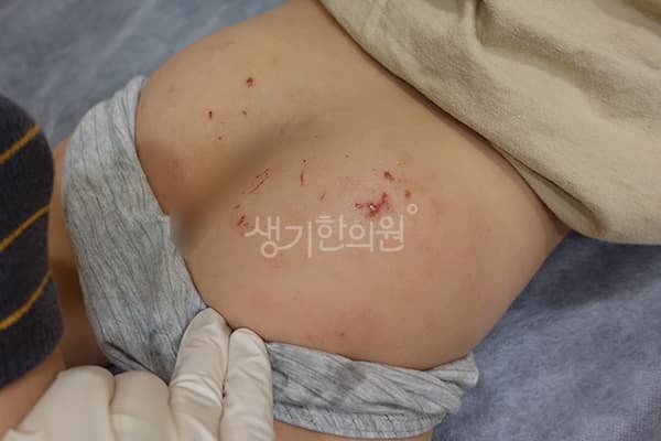 소아아토피 치료 전 사진 — 일산점, 치료 기간 5개월