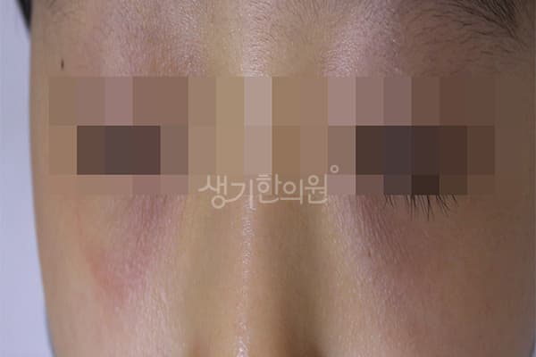 소아아토피 치료 전 사진 — 인천점, 치료 기간 6개월