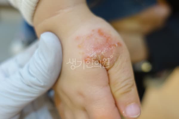 소아아토피 치료 전 사진 — 노원점, 치료 기간 4개월