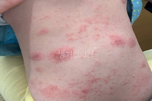 소아아토피 치료 전 사진 — 신도림점, 치료 기간 4개월