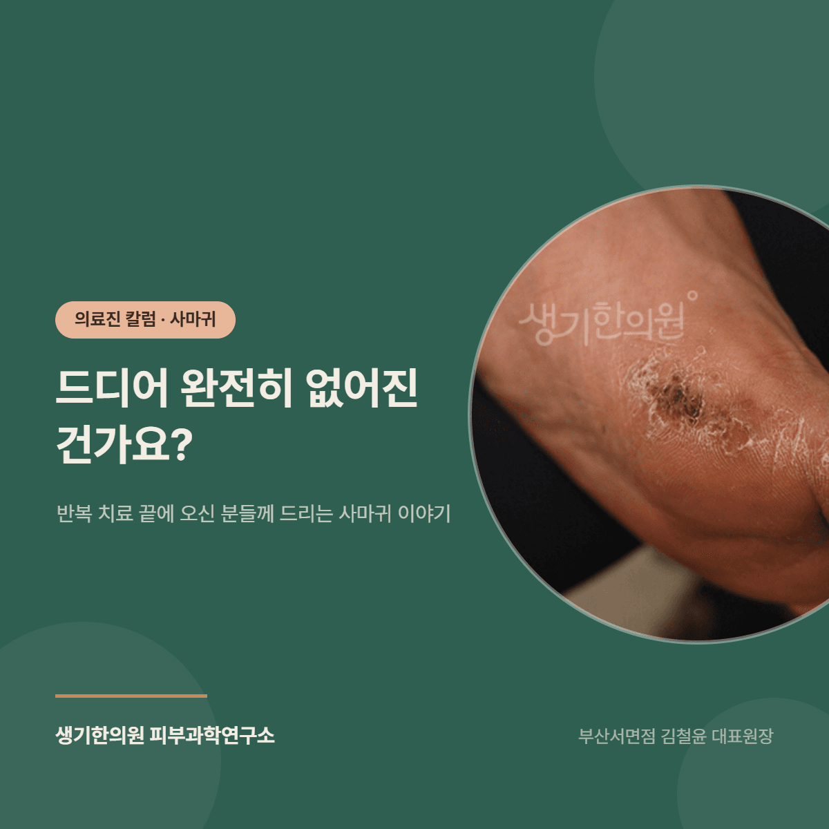 드디어 완전히 없어진 건가요? — 반복 치료 끝에 오신 분들께 드리는 사마귀 이야기 대표 이미지