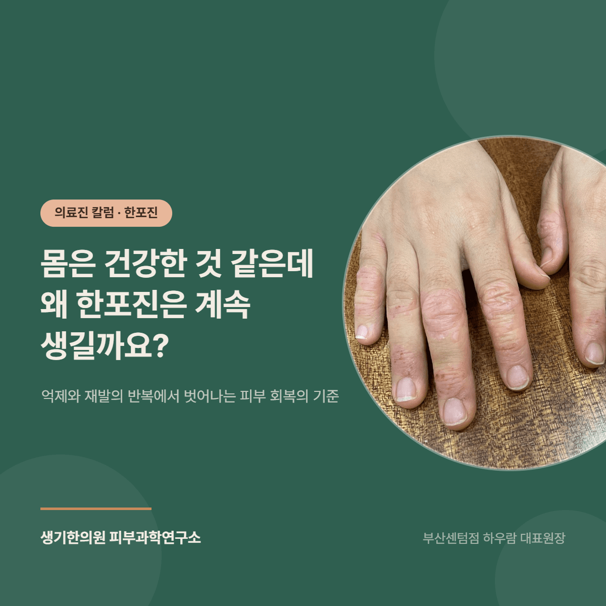 몸은 건강한 것 같은데 왜 한포진은 계속 생길까요? — 억제와 재발의 반복에서 벗어나는 피부 회복의 기준 대표 이미지