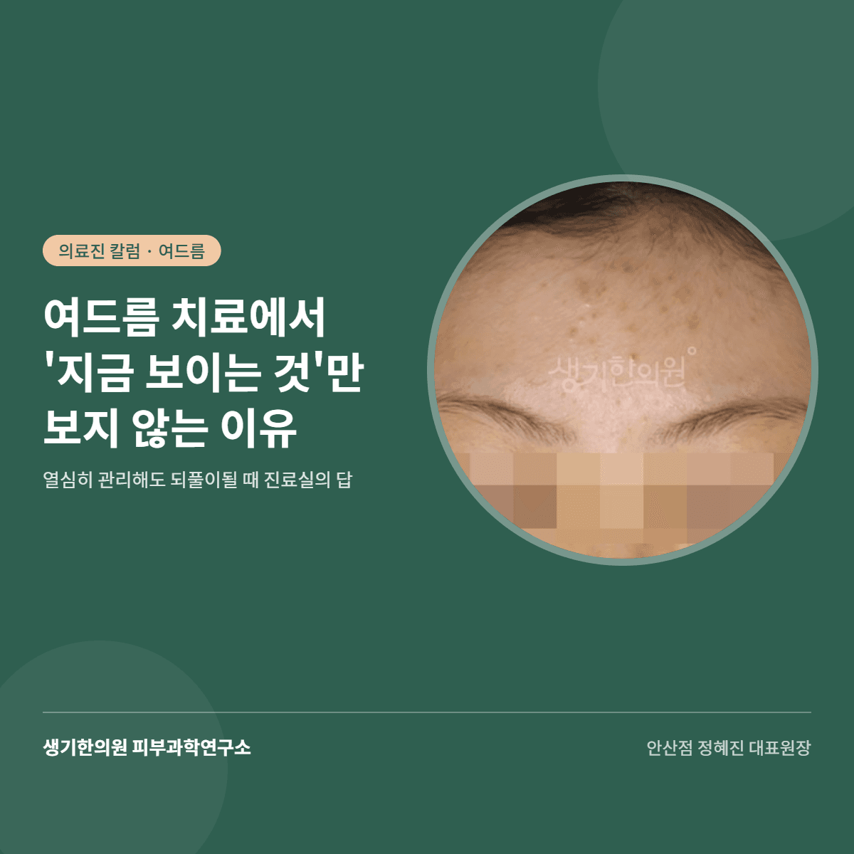 여드름 치료에서 '지금 보이는 것'만 보지 않는 이유 — 열심히 관리해도 되풀이될 때 진료실에서 드리는 답 대표 이미지