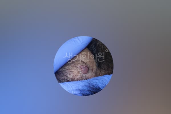 곤지름 치료 전 사진 — 천안아산점, 치료 기간 3개월