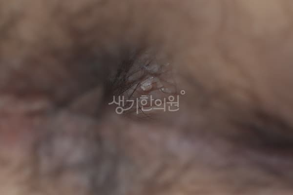 곤지름 치료 전 사진 — 천안아산점, 치료 기간 3개월