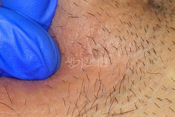 곤지름 치료 전 사진 — 천안아산점, 치료 기간 3개월