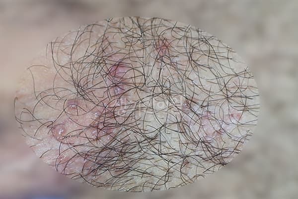 곤지름 치료 전 사진 — 천안아산점, 치료 기간 3개월