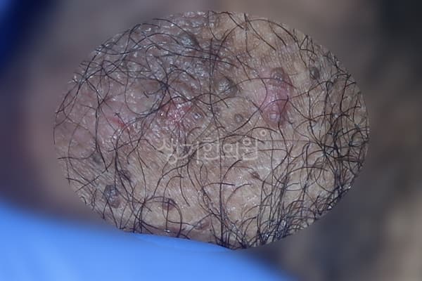 곤지름 치료 전 사진 — 천안아산점, 치료 기간 3개월