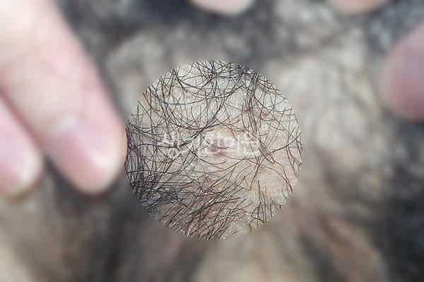 곤지름 치료 전 사진 — 천안아산점, 치료 기간 3개월