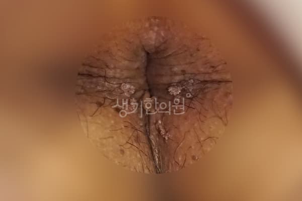 곤지름 치료 전 사진 — 대구점, 치료 기간 5개월
