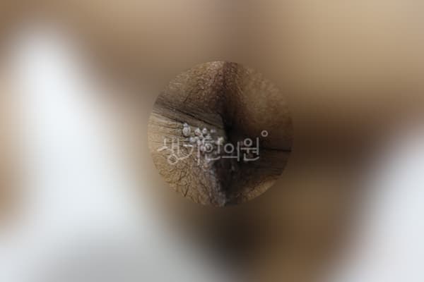 곤지름 치료 전 사진 — 광주점, 치료 기간 5개월