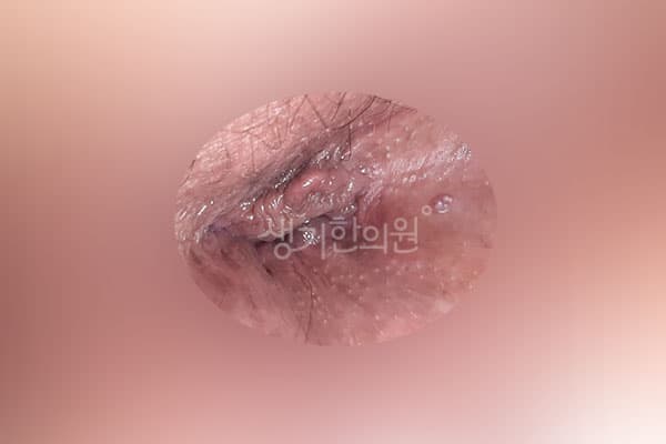 곤지름 치료 전 사진 — 신도림점, 치료 기간 3개월