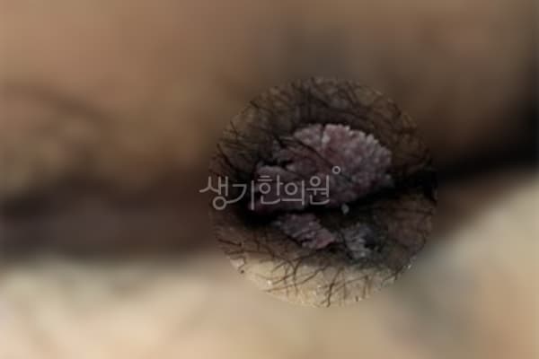 곤지름 치료 전 사진 — 신도림점, 치료 기간 4개월