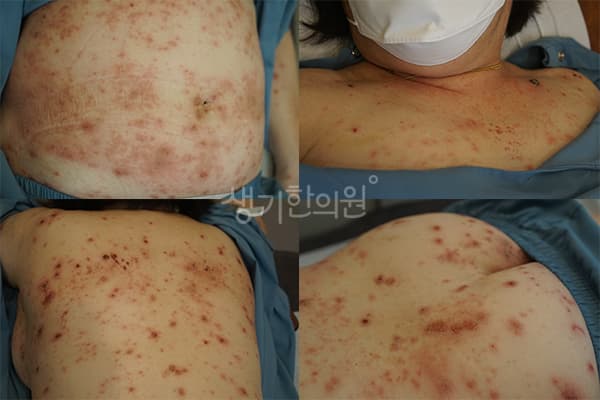 습진 치료 전 사진 — 부산센텀점, 치료 기간 7개월