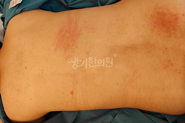 습진 치료 전 사진 — 부산센텀점, 치료 기간 3개월
