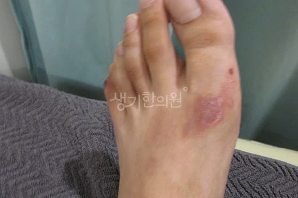 습진 치료 전 사진 — 부산서면점, 치료 기간 6개월