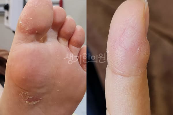 습진 치료 전 사진 — 대전점, 치료 기간 9개월