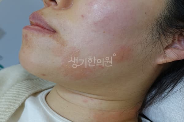 습진 치료 전 사진 — 일산점, 치료 기간 3개월