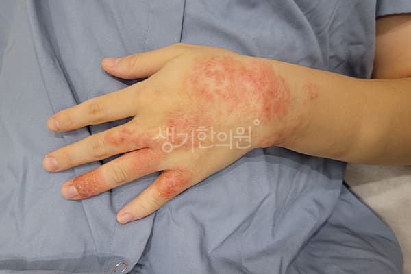 습진 치료 전 사진 — 마포공덕점, 치료 기간 6개월