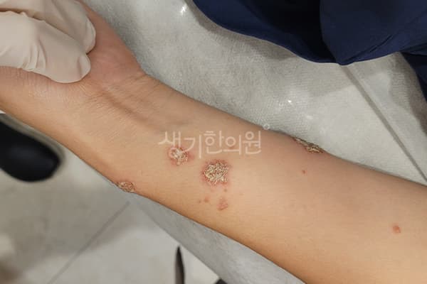 습진 치료 전 사진 — 마포공덕점, 치료 기간 4개월