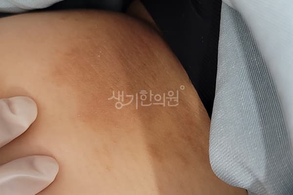 습진 치료 전 사진 — 마포공덕점, 치료 기간 8개월