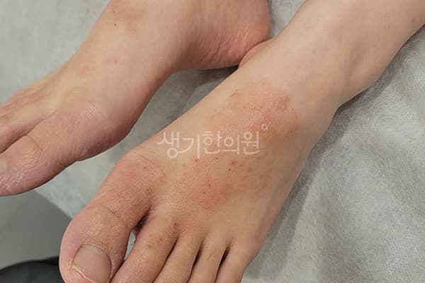습진 치료 전 사진 — 마포공덕점, 치료 기간 8개월