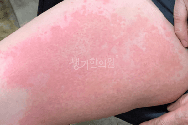습진 치료 전 사진 — 신도림점, 치료 기간 5개월