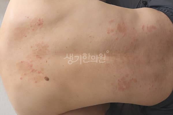 습진 치료 전 사진 — 수원점, 치료 기간 2개월