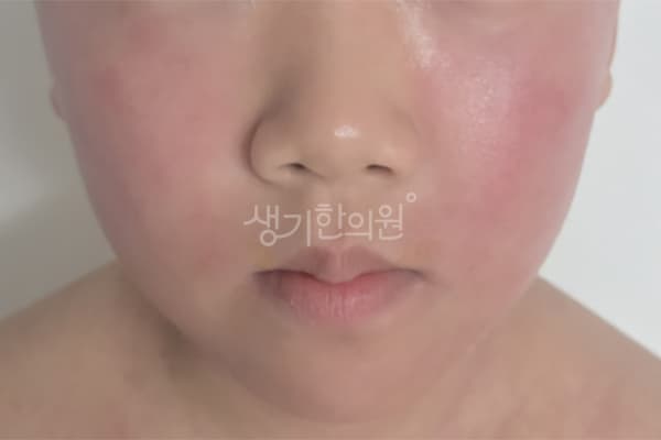 안면홍조 치료 전 사진 — 창원점, 치료 기간 5개월