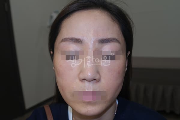 안면홍조 치료 전 사진 — 천안아산점, 치료 기간 3개월