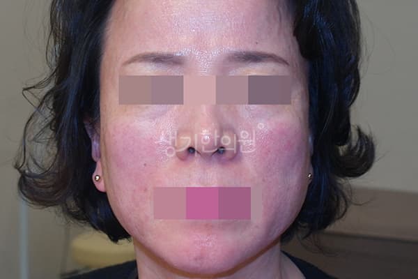 안면홍조 치료 전 사진 — 천안아산점, 치료 기간 3개월